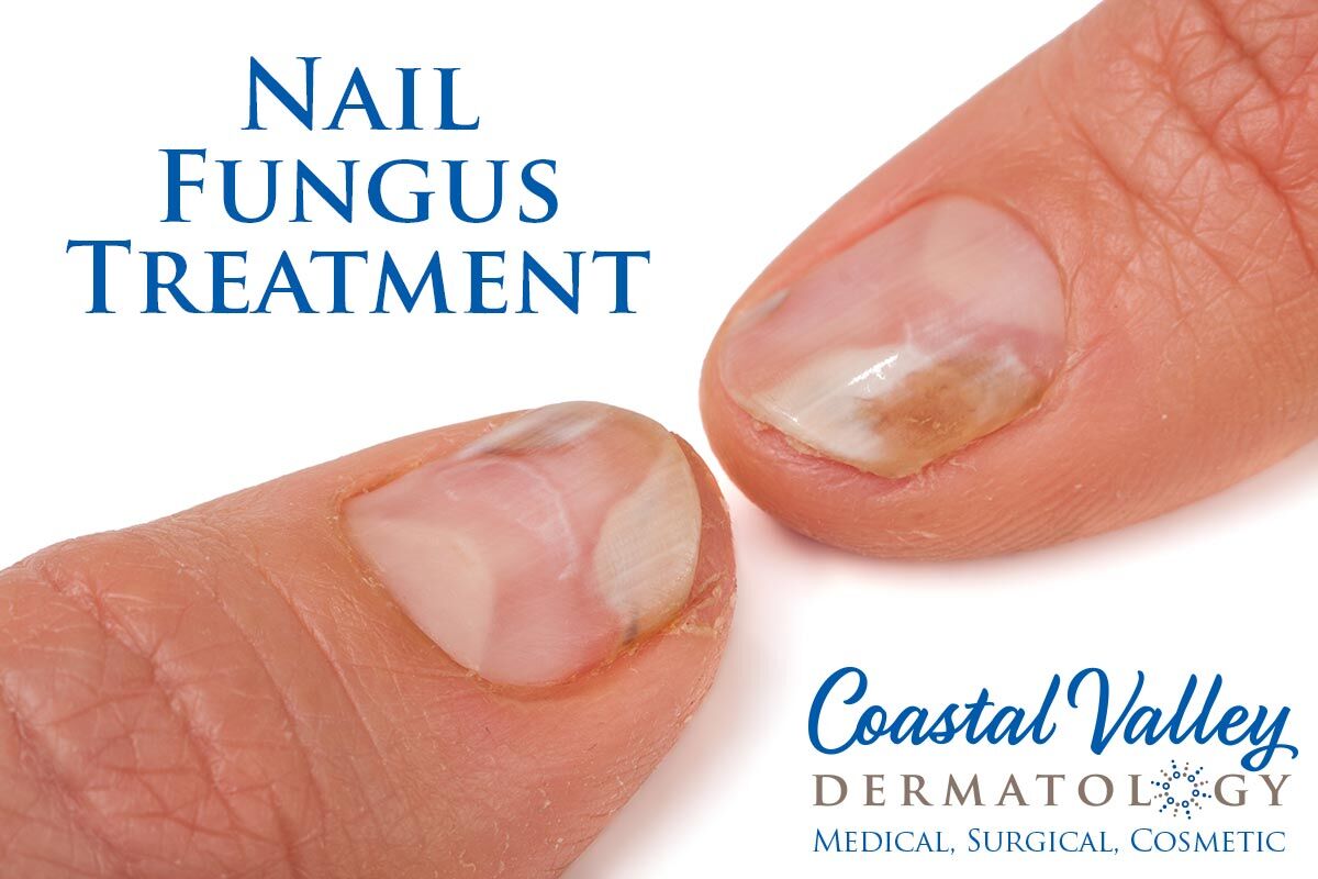 Nail Fungus   Coastal Valley Dermatology